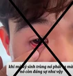 Chiêu trò lôi 'ký sinh trùng' ra từ mắt