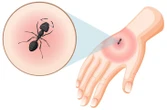 Thực hư chuyện dùng kiến để xua đuổi muỗi truyền bệnh chikungunya
