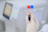 Đi khám sức khỏe phát hiện huyết thanh đục như sữa, nguy cơ đột quỵ cao