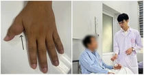 Tưởng 'thịt thừa' ở ngón tay, không ngờ là khối u ăn mòn xương