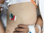 Ca mắc não mô cầu phía Nam tăng cao, nguy cơ xuất hiện thêm ca bệnh cộng đồng