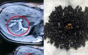 Ký sinh trùng chui lên đường mật nguy hiểm ra sao?