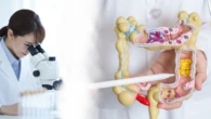 Phương pháp mới phát hiện 90% ca ung thư đại trực tràng không cần nội soi