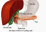 Viên sỏi túi mật: ‘Quả bom nổ chậm’ gây tắc ruột