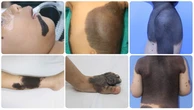 Mảng đen trên da trẻ không chỉ là thẩm mỹ mà còn tiềm ẩn nguy cơ ung thư
