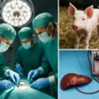 Mỹ thử nghiệm dùng gan heo chỉnh sửa gene trị suy gan cấp tính ở người