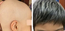 Bé gái 7 tuổi bị rụng hết tóc được điều trị thành công