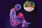 Dịch Chikungunya lan rộng liệu có nguy hiểm?
