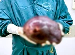 Cắt khối u gan khổng lồ nặng 2,5kg