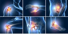 Thoái hóa khớp giai đoạn sớm: Nên bắt đầu bằng thuốc bôi tại chỗ và tập luyện