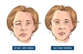 Nhiễm lạnh, trúng gió: Nguy cơ dẫn đến liệt dây thần kinh số 7 ngoại biên