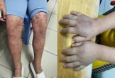 Cảnh báo bệnh ban xuất huyết Schonlein - Henoch gây biến chứng thận nguy hiểm ở trẻ em