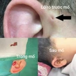 Gia đình 3 thế hệ cùng mắc bệnh ít gặp rò luân nhĩ: Bệnh có nguy hiểm không?