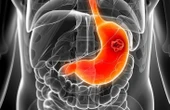 Cách trị viêm loét dạ dày - tá tràng qua bữa ăn