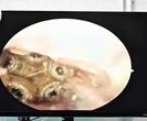 Nữ bệnh nhân nhập viện vì đau tai, bác sĩ gắp ra 5 con giòi sống