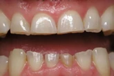 Tại sao nhiều người ngủ lại nghiến răng, có điều trị được không?