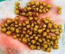Mổ cấp cứu nữ bệnh nhân có hơn 100 viên sỏi chứa đầy trong túi mật