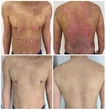 Bệnh vảy nến có thể trị khỏi được không?