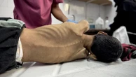 Sete novos palestinos morrem de fome em Gaza; mortes chegam a 154