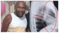Homem que ficou com instrumento médico preso na jugular deve ser indenizado