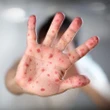 Vírus ressurgiu com força: Canadá perde status de país livre do sarampo