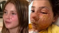 Menina australiana sofre queimaduras severas após tentar desafio nas redes