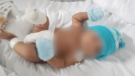 Bebê de 2 meses tem pé amputado após bronquiolite e mãe cita erro médico