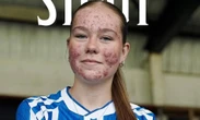 Sokkerwêreld skaar hom agter tiener wat oor haar aknee gespot word