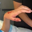 Meisie (14) se duim gebreek in robaanval