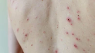 Minister urges take-up of chickenpox jab to defeat vaccine conspiracy theorists