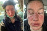 I thought it looked like I had survived a fire, then I learned about Topical Steroid Withdrawal