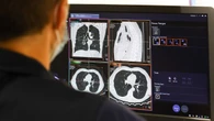 NHS trust warned of ‘neglect’ after failure to spot patient’s fatal lung cancer