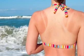 How to treat sunburn at home – and when to see a doctor