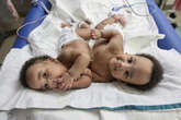 Twin boys born conjoined celebrate 1st birthday after separation surgery