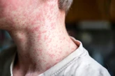 What to know about measles as Glastonbury-goers warned of surge