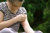 6 insect bites and stings to watch out for