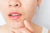 Acne crushed my confidence growing up. Seeing teen footballer Skye Stout would’ve changed everything