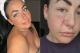 I never wore sunscreen. I've now got a 7.5cm scar after skin cancer diagnosis