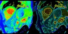 Las técnicas de imagen muestran el daño que causan la carnes rojas sobre el corazón