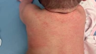 Alberta surpasses all of the United States in confirmed measles cases