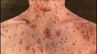New measles cases detected in B.C.’s Interior, including airports