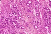 New radiation drug shows improved survival in prostate cancer patients