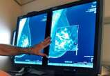 Breast cancer is rising among U.S. young women even as deaths drop: study