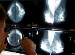 Begin breast cancer screening at age 40, Canadian Cancer Society urges