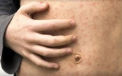 Measles cases continue to rise in Manitoba as outbreaks spread