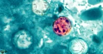 86 people have been hospitalized with the foodborne parasite spreading across the U.S., the CDC said 