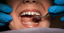 Rotten result? Kids could have millions more cavities if every state banned fluoride, report predicts