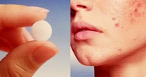 The most popular pill to treat women's acne is a blood pressure drug