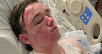 McDonald’s worker suffers severe burns on face and body after coworker throws hot oil on him