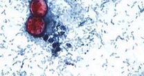 Cases of illness that causes explosive diarrhea on the rise across the U.S.